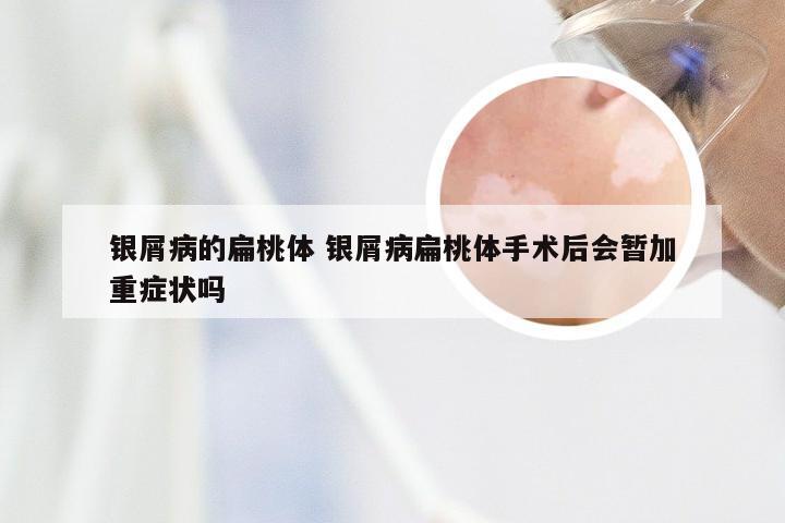 银屑病的扁桃体 银屑病扁桃体手术后会暂加重症状吗