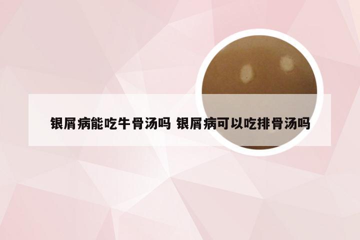 银屑病能吃牛骨汤吗 银屑病可以吃排骨汤吗