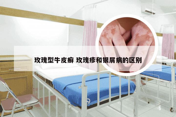玫瑰型牛皮癣 玫瑰疹和银屑病的区别