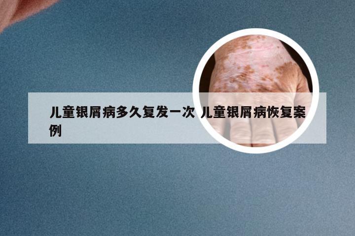 儿童银屑病多久复发一次 儿童银屑病恢复案例