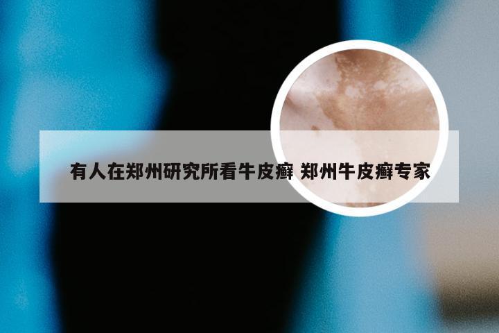 有人在郑州研究所看牛皮癣 郑州牛皮癣专家