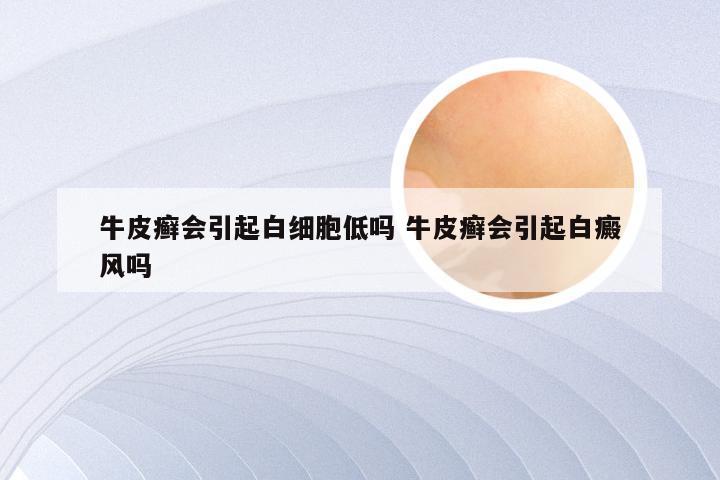 牛皮癣会引起白细胞低吗 牛皮癣会引起白癜风吗