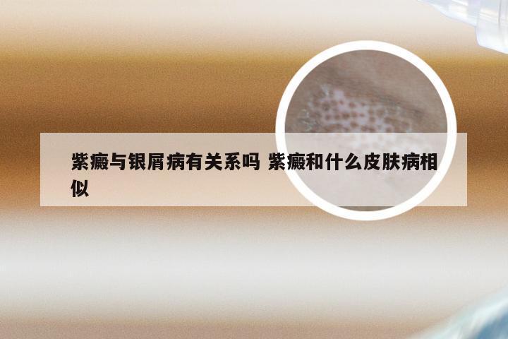 紫癜与银屑病有关系吗 紫癜和什么皮肤病相似