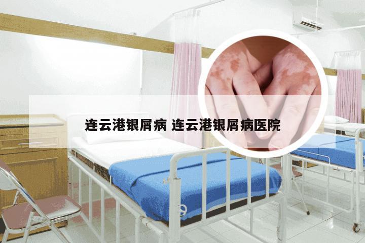 连云港银屑病 连云港银屑病医院