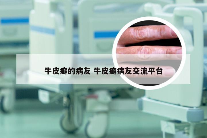 牛皮癣的病友 牛皮癣病友交流平台