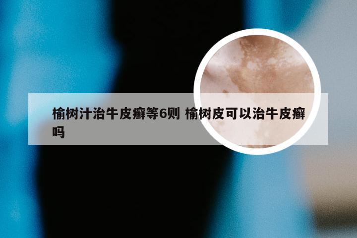 榆树汁治牛皮癣等6则 榆树皮可以治牛皮癣吗