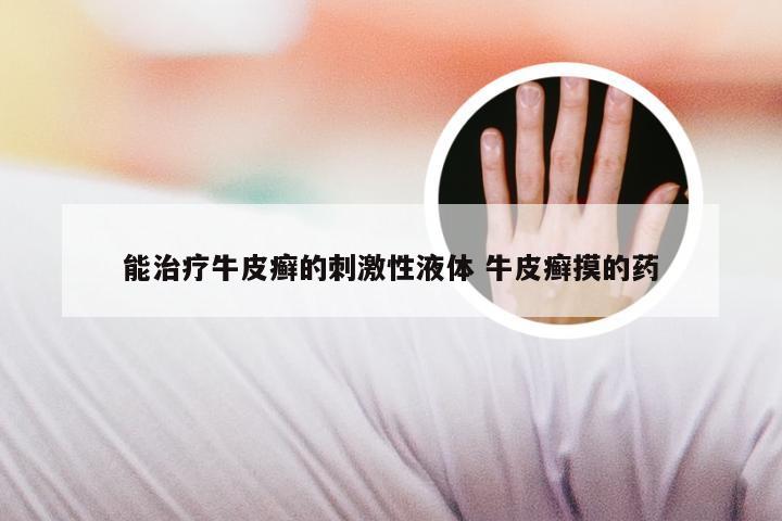 能治疗牛皮癣的刺激性液体 牛皮癣摸的药