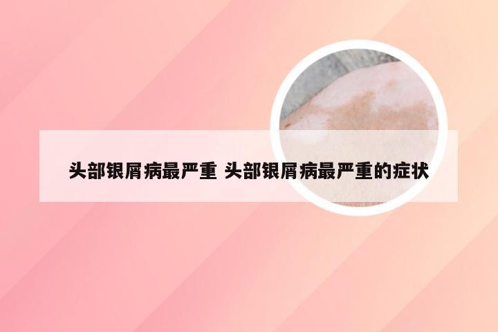 头部银屑病最严重 头部银屑病最严重的症状