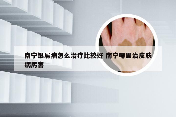 南宁银屑病怎么治疗比较好 南宁哪里治皮肤病厉害