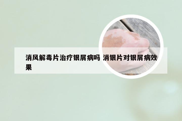 消风解毒片治疗银屑病吗 消银片对银屑病效果