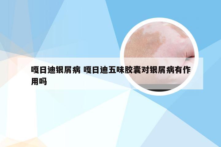 嘎日迪银屑病 嘎日迪五味胶囊对银屑病有作用吗