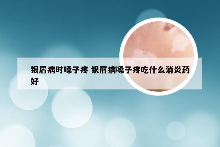 银屑病时嗓子疼 银屑病嗓子疼吃什么消炎药好