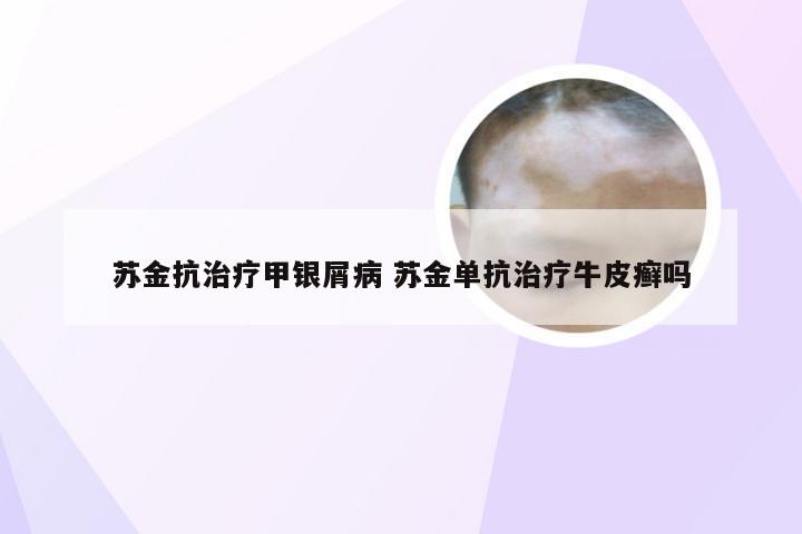 苏金抗治疗甲银屑病 苏金单抗治疗牛皮癣吗
