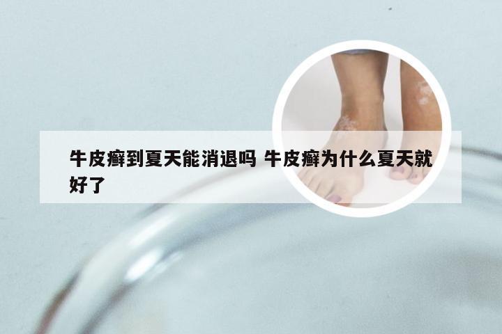 牛皮癣到夏天能消退吗 牛皮癣为什么夏天就好了