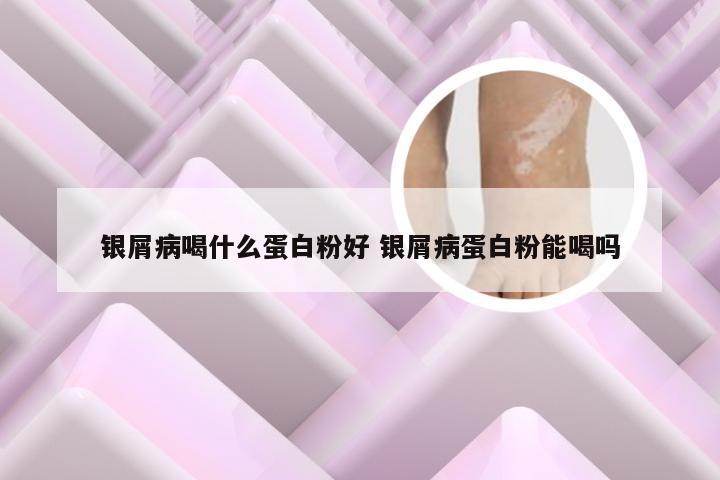 银屑病喝什么蛋白粉好 银屑病蛋白粉能喝吗