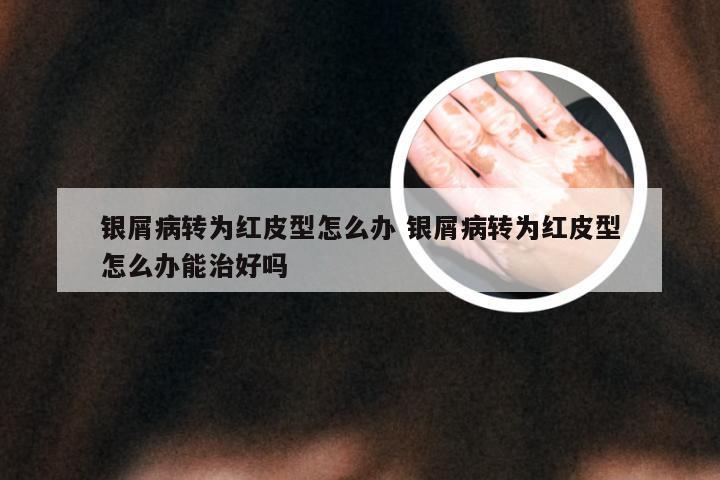 银屑病转为红皮型怎么办 银屑病转为红皮型怎么办能治好吗