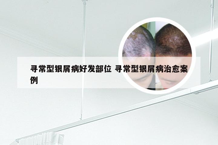寻常型银屑病好发部位 寻常型银屑病治愈案例