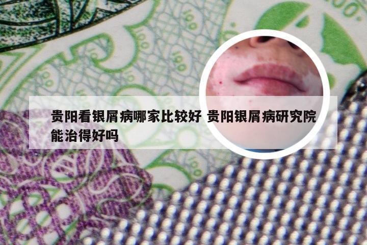贵阳看银屑病哪家比较好 贵阳银屑病研究院能治得好吗