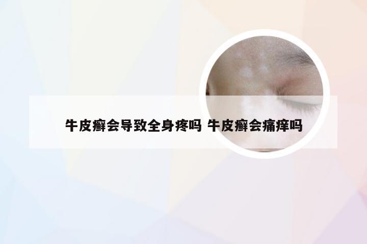 牛皮癣会导致全身疼吗 牛皮癣会痛痒吗