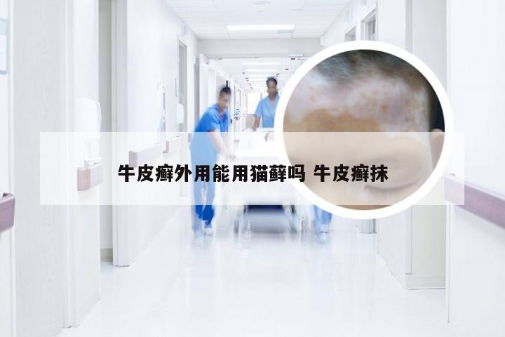 牛皮癣外用能用猫藓吗 牛皮癣抹