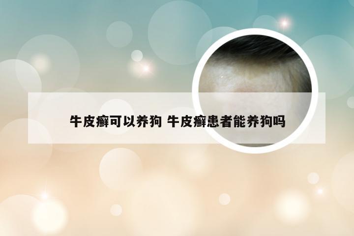 牛皮癣可以养狗 牛皮癣患者能养狗吗