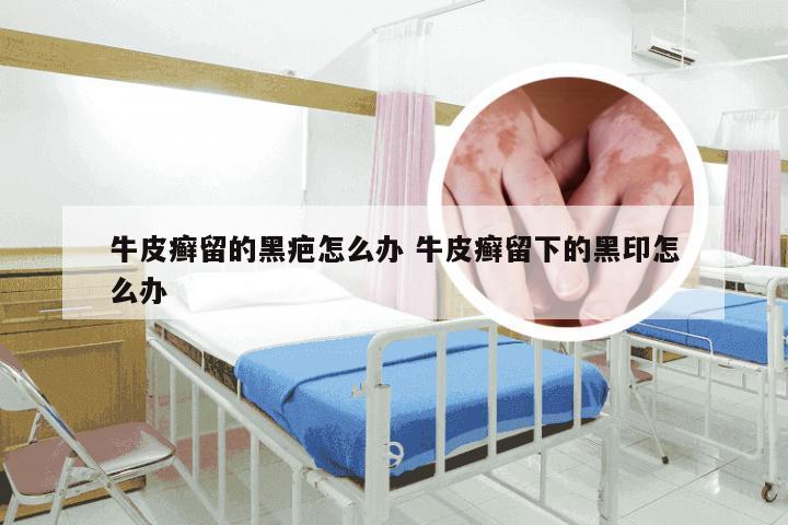 牛皮癣留的黑疤怎么办 牛皮癣留下的黑印怎么办