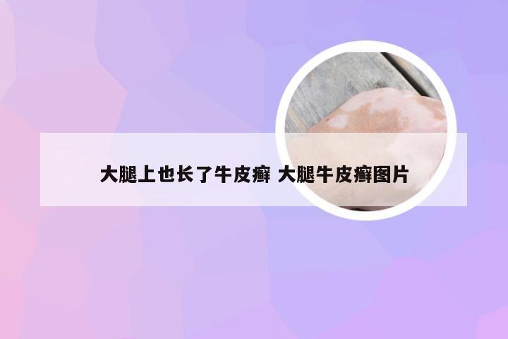 大腿上也长了牛皮癣 大腿牛皮癣图片
