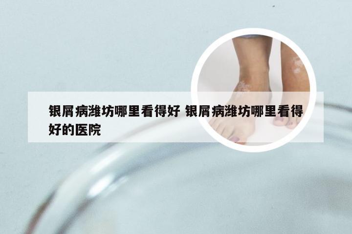 银屑病潍坊哪里看得好 银屑病潍坊哪里看得好的医院