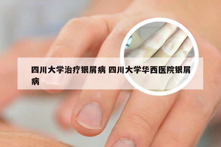 四川大学治疗银屑病 四川大学华西医院银屑病