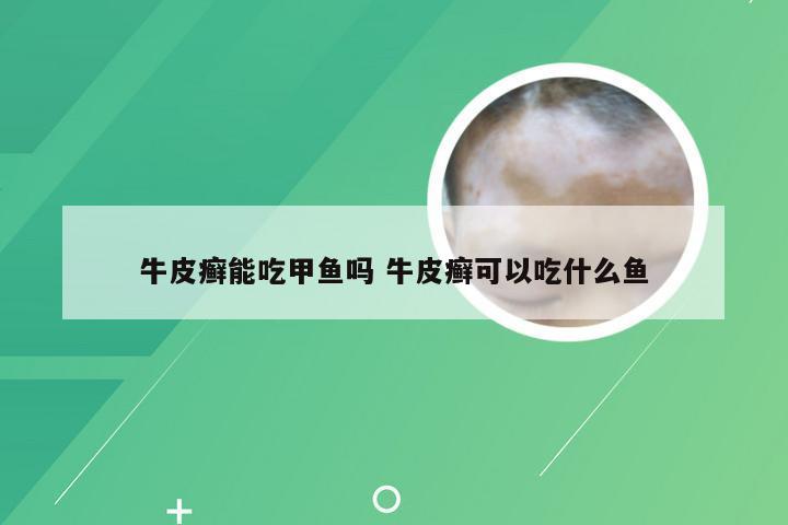 牛皮癣能吃甲鱼吗 牛皮癣可以吃什么鱼