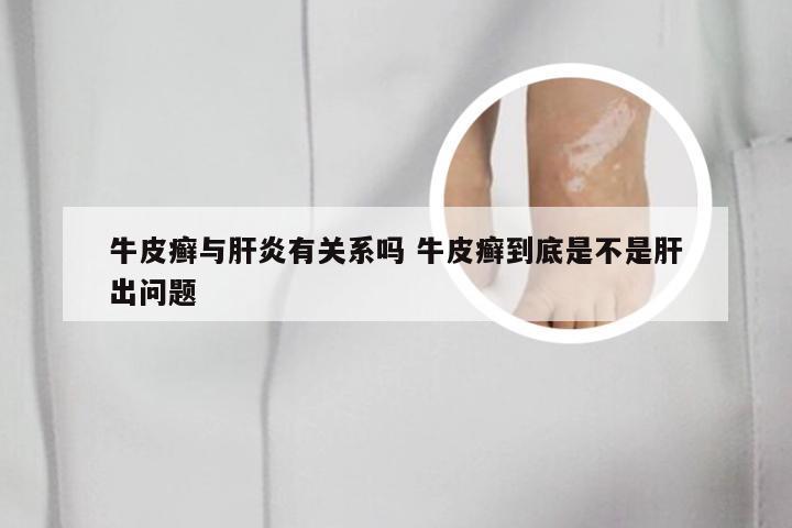 牛皮癣与肝炎有关系吗 牛皮癣到底是不是肝出问题