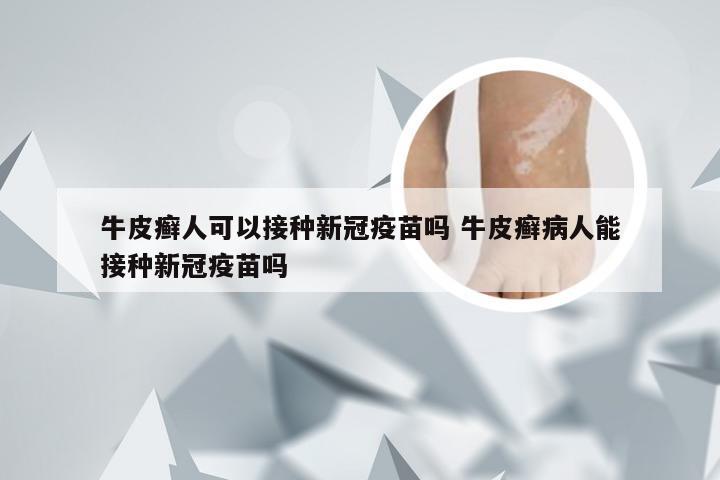 牛皮癣人可以接种新冠疫苗吗 牛皮癣病人能接种新冠疫苗吗