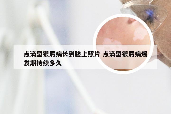 点滴型银屑病长到脸上照片 点滴型银屑病爆发期持续多久