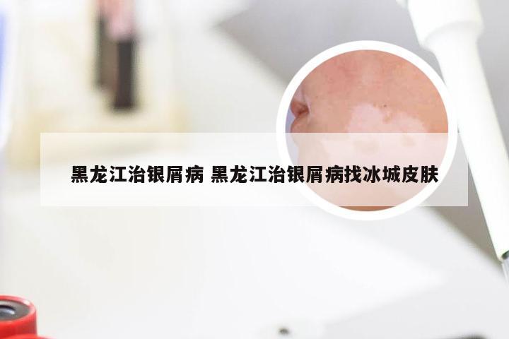 黑龙江治银屑病 黑龙江治银屑病找冰城皮肤