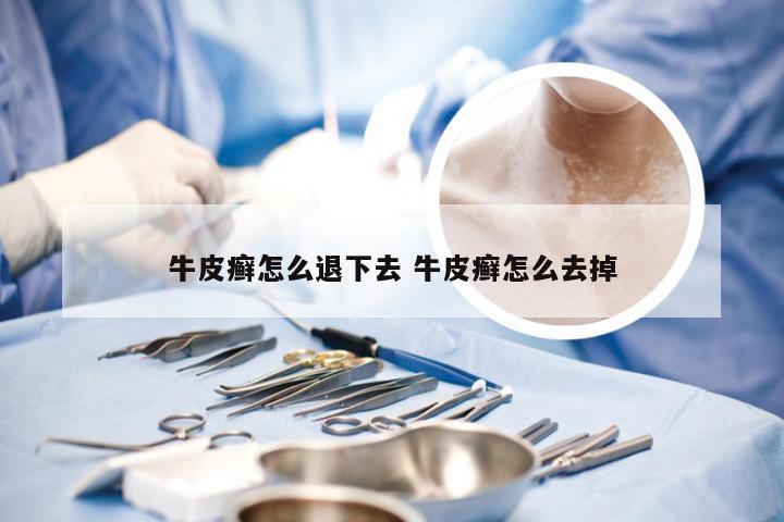 牛皮癣怎么退下去 牛皮癣怎么去掉