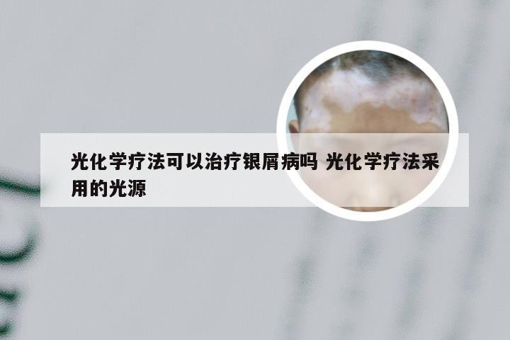 光化学疗法可以治疗银屑病吗 光化学疗法采用的光源