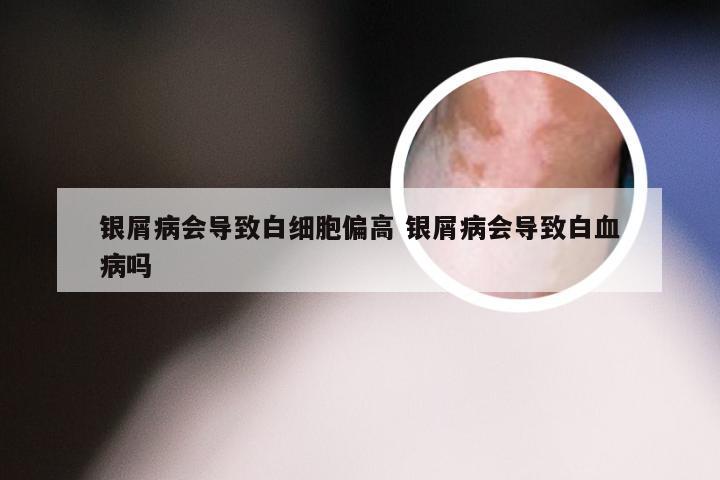 银屑病会导致白细胞偏高 银屑病会导致白血病吗