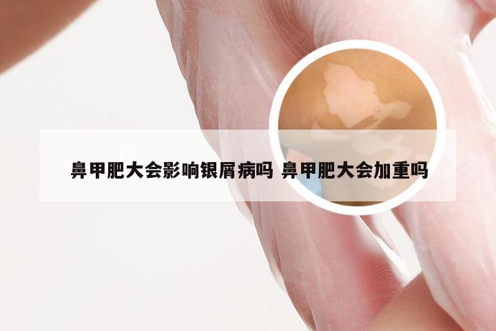鼻甲肥大会影响银屑病吗 鼻甲肥大会加重吗