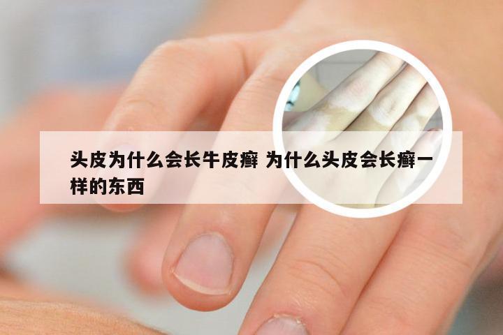 头皮为什么会长牛皮癣 为什么头皮会长癣一样的东西