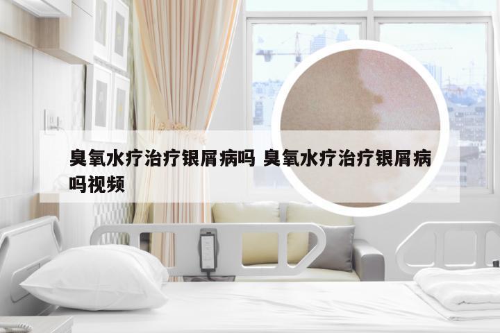 臭氧水疗治疗银屑病吗 臭氧水疗治疗银屑病吗视频