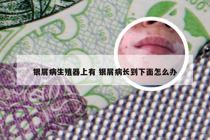 银屑病生殖器上有 银屑病长到下面怎么办
