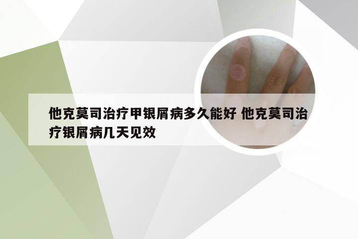 他克莫司治疗甲银屑病多久能好 他克莫司治疗银屑病几天见效