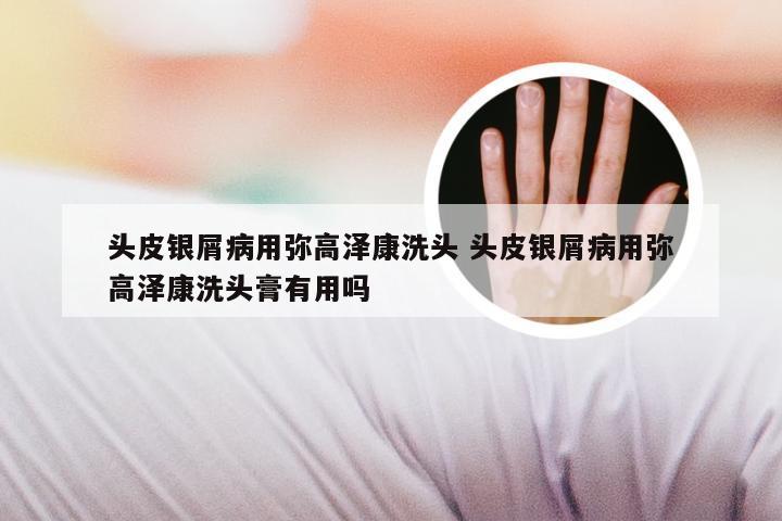 头皮银屑病用弥高泽康洗头 头皮银屑病用弥高泽康洗头膏有用吗