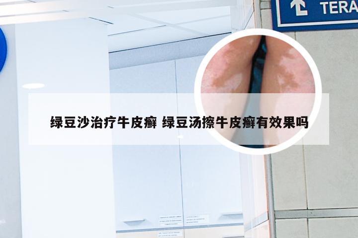绿豆沙治疗牛皮癣 绿豆汤擦牛皮癣有效果吗