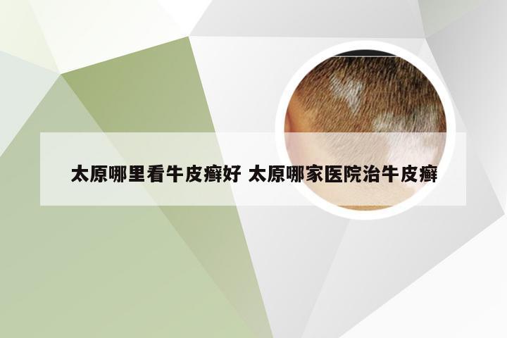 太原哪里看牛皮癣好 太原哪家医院治牛皮癣