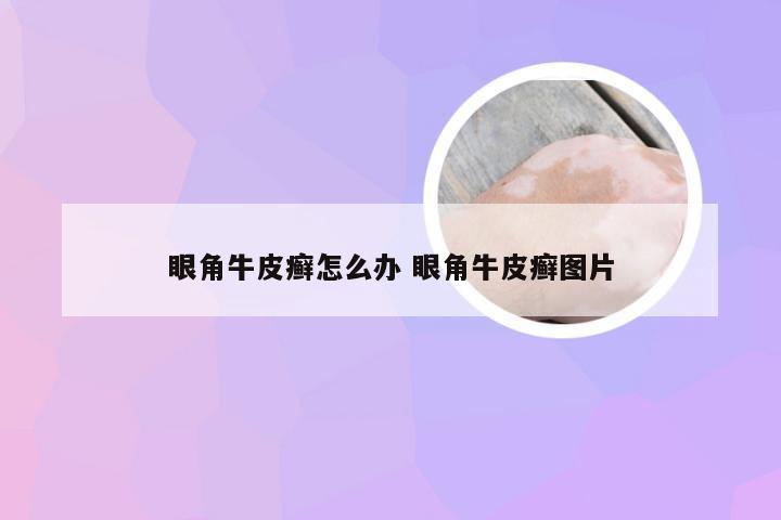 眼角牛皮癣怎么办 眼角牛皮癣图片