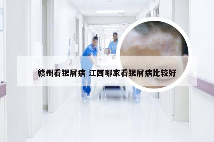 赣州看银屑病 江西哪家看银屑病比较好