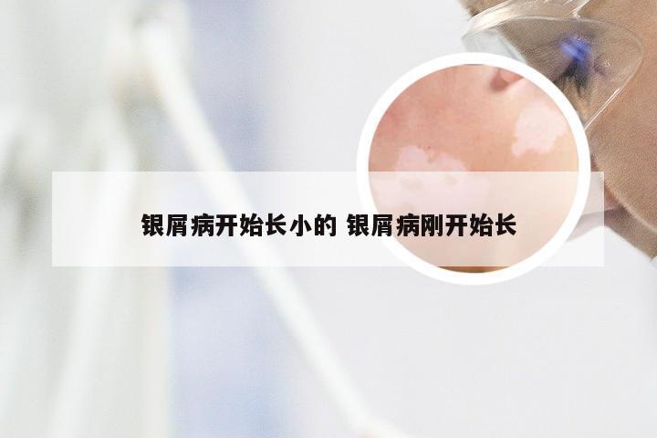 银屑病开始长小的 银屑病刚开始长