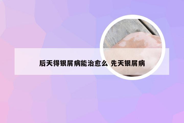 后天得银屑病能治愈么 先天银屑病
