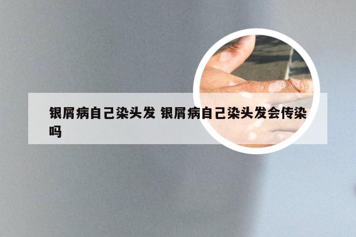 银屑病自己染头发 银屑病自己染头发会传染吗